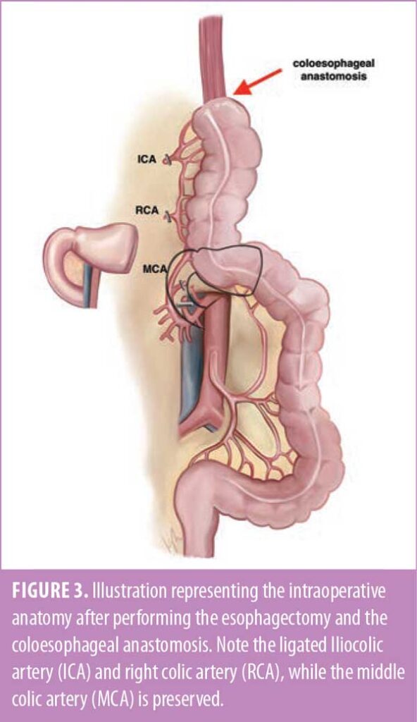 Colonic Interposition Graft As A Conduit Following Esophagectomy For