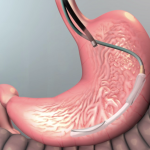 Intragastric Balloons: Closing the Gap on Weight Loss Treatment Options