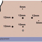 Laparoscopic Antecolic-antegastric Roux-en-Y Gastro-jejunal Anastomosis using a Combined Linear Stapler and Hand-sewn Technique