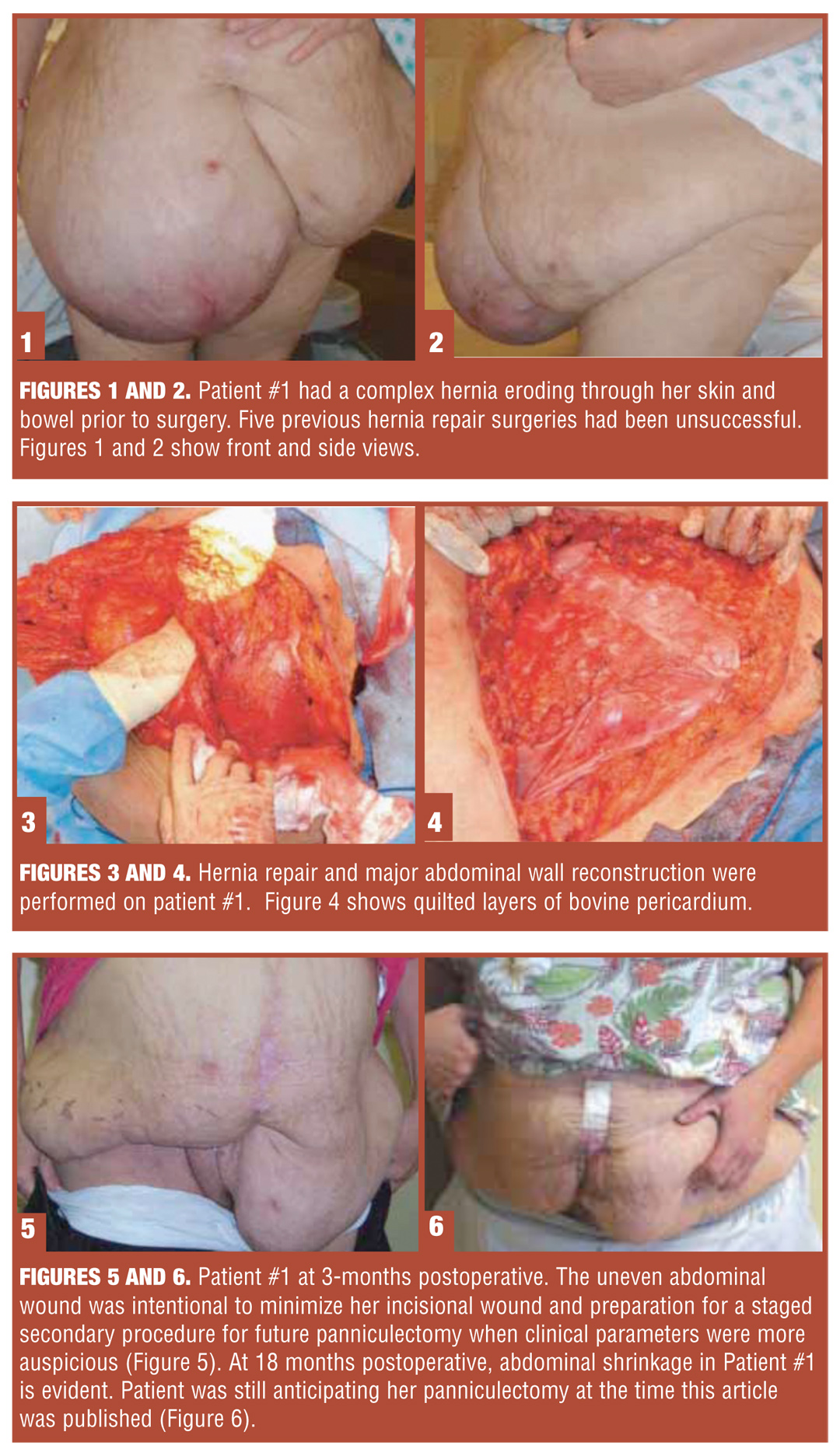 Use of Bovine Pericardium in Complex Hernia Repair