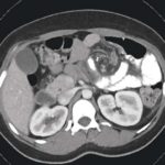 Chylous Ascites Associated With Internal Hernia After Laparoscopic Roux-en-Y Gastric Bypass For Morbid Obesity: A Case Report