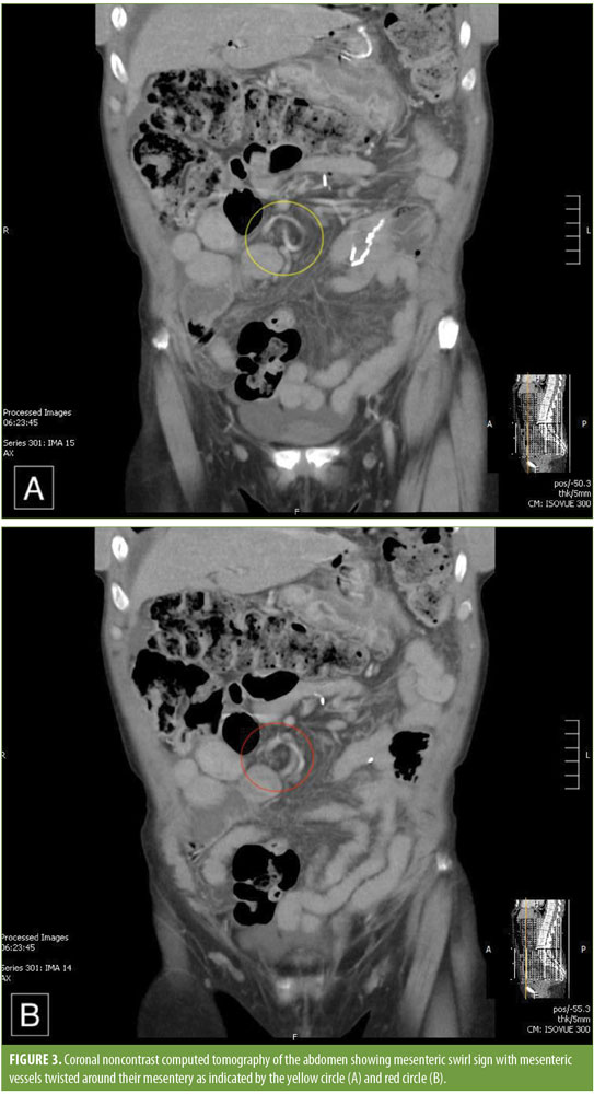 marginal ulcer