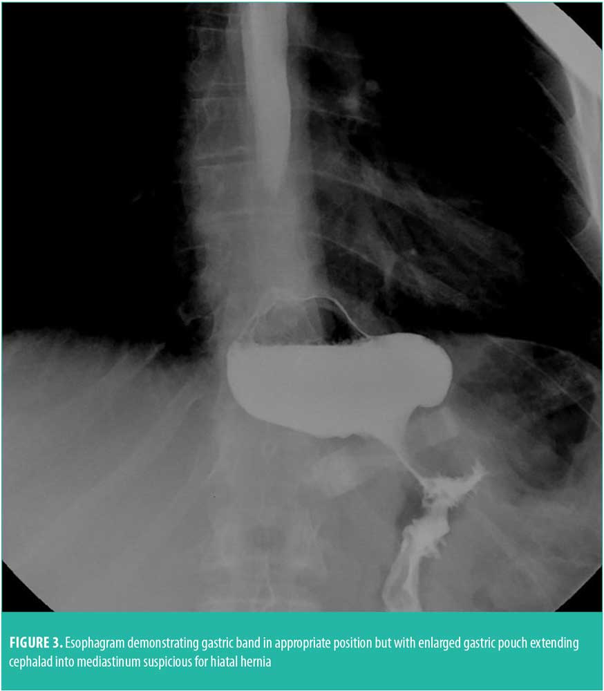 Management of LongTerm Complications of Gastric Banding and Gastric