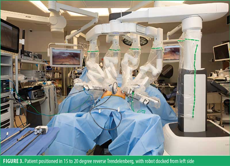 operación Verde Horizontal Robotic Single-Anastomosis Duodenoileal (SADI) Bypass After Sleeve  Gastrectomy for Insufficient Weight Loss : Bariatric Times