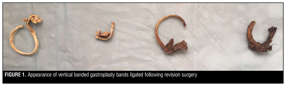 vertical banded gastroplasty before and after