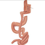 Jejunal Interposition as a Definitive Treatment for Gastric Fistula after Sleeve Gastrectomy
