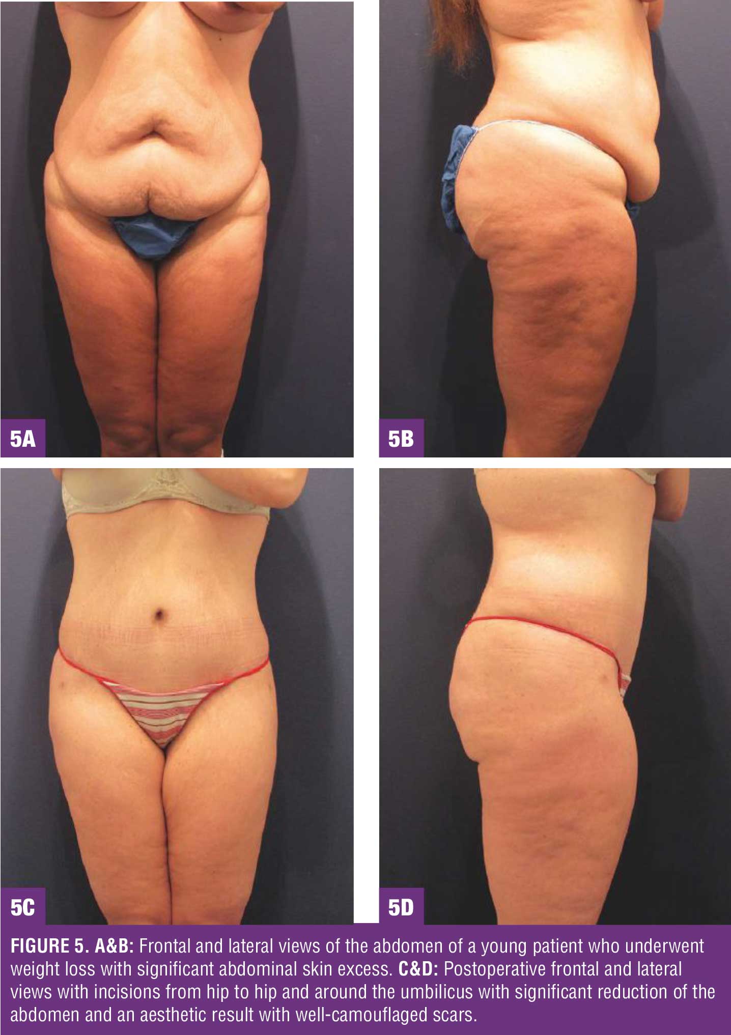 Limited Incision Bodylift From Head To Toe For The Massive Weight Loss  Patient : Bariatric Times