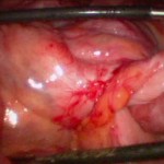 Late Onset Abdominal Pain After Gastric Bypass Due to a Rare Diagnosis—Jejuno-Jejunostomy Volvulus