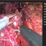 Laparoscopic Roux-En-Y Fistulo-jejunostomy as a Salvage Procedure in Patients with Persistent Post-Sleeve Gastrectomy Fistula