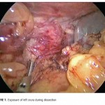 Initial Outcomes Following Laparoscopic Sleeve Gastrectomy in 292 Patients as a Single-stage Procedure for Morbid Obesity