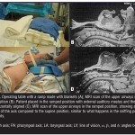Airway Management in Bariatric Surgery: A Challenge for Anesthesiologists