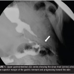 Endoscopic Management of Persistent Leak after Laparoscopic Sleeve Gastrectomy:  A Case Report