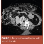 Ventral Hernias in Bariatric Surgery