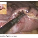Laparoscopic Greater Curvature Plication: An Alternative Restrictive Bariatric Procedure