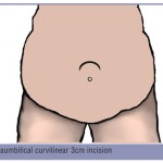 How to Perform an Evaluation and Reduction of Internal Hernia Via a Laparoscopic  Single Incision