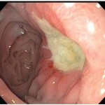 Marginal Ulcers after Roux-en-Y Gastric Bypass: Pain for the Patient…Pain for the Surgeon