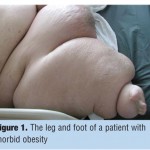 Maintaining Dignity of Patients with Morbid Obesity in the Hospital Setting